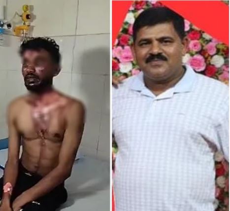 ಮನೆಗೆ ಬಂದ ಮಗಳ ಪ್ರೇಮಿಗೆ ಕುದಿಯುವ ನೀರು ಎರಚಿದ ತಂದೆ-ಯುವಕನಿಗೆ ಜಿಲ್ಲಾಸ್ಪತ್ರೆಯಲ್ಲಿ ಚಿಕಿತ್ಸೆ