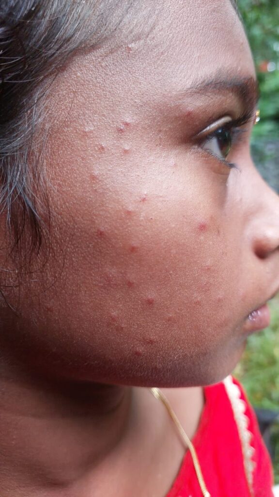 ಸೊಳ್ಳೆಯ ಕಾಟದಿಂದ ನಿದ್ರಿಸುತ್ತಿಲ್ಲ ಅಮರ ಪಡ್ನೂರು ಗ್ರಾಮದ ಜನ