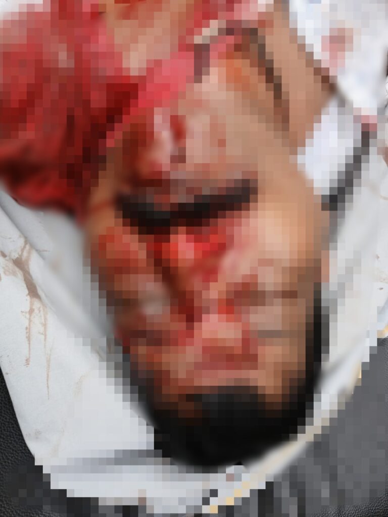 ಬೈಕ್‍-ಪಿಕಪ್ ಡಿಕ್ಕಿ : ಬೈಕ್ ಸವಾರ  ಸುರೇಶ್‍ ಭಂಡಾರಿ ಮೃತ್ಯು.