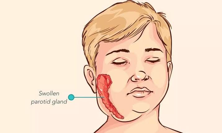 ಸುಳ್ಯ ತಾಲೂಕಿನಲ್ಲಿ  ಹೆಚ್ಚುತ್ತಿರುವ ಕೆಪ್ಪಟ್ರಾಯ ಬಾಧೆ(ಮಂಗನಬಾವು-ಮಂಪ್ಸ್) ಶಾಲಾ ಮಕ್ಕಳಲ್ಲಿ ಒಬ್ಬರಿಂದ ಮತ್ತೊಬ್ಬರಿಗೆ ಹರಡುತ್ತಿದೆ